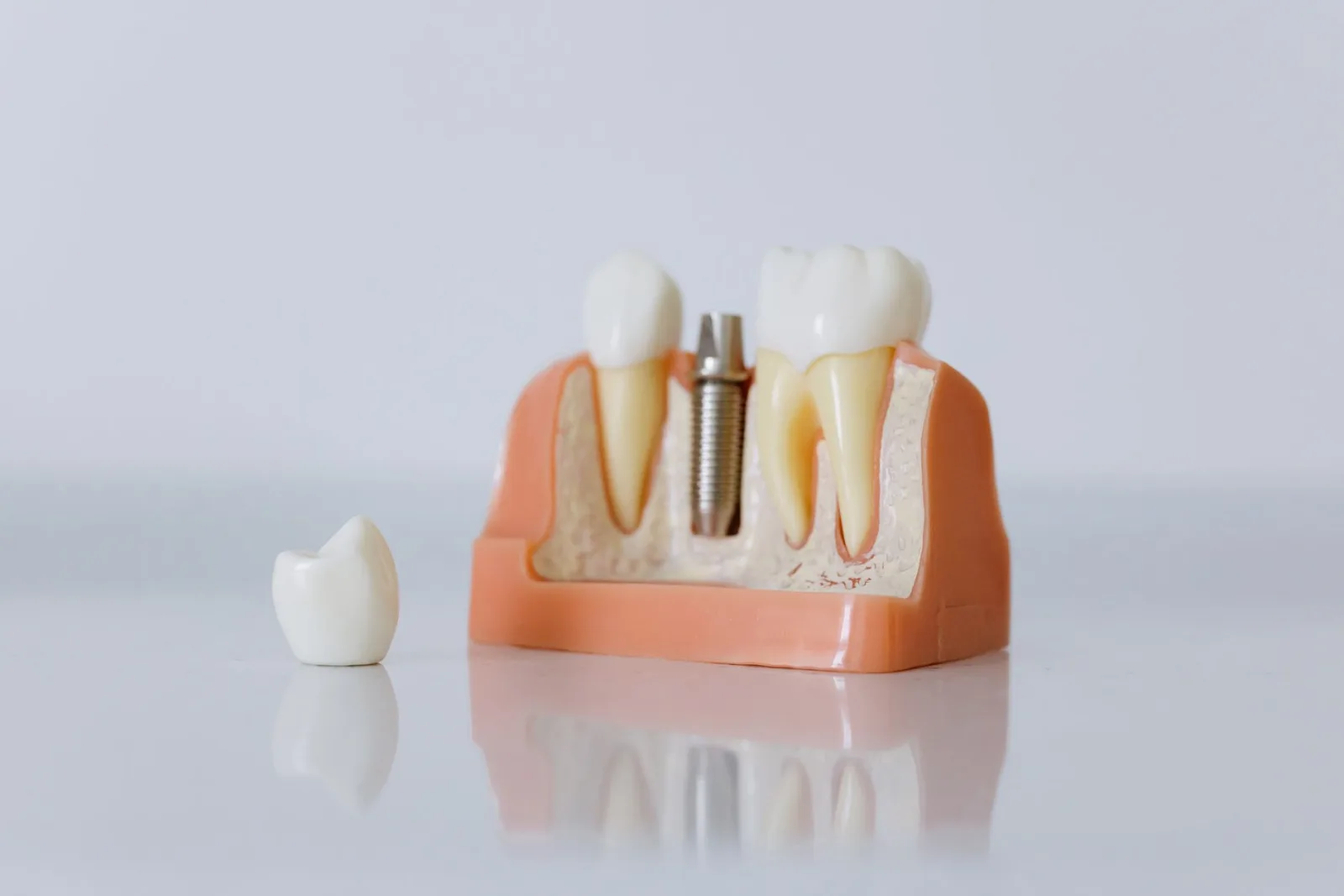 Dental implant system components