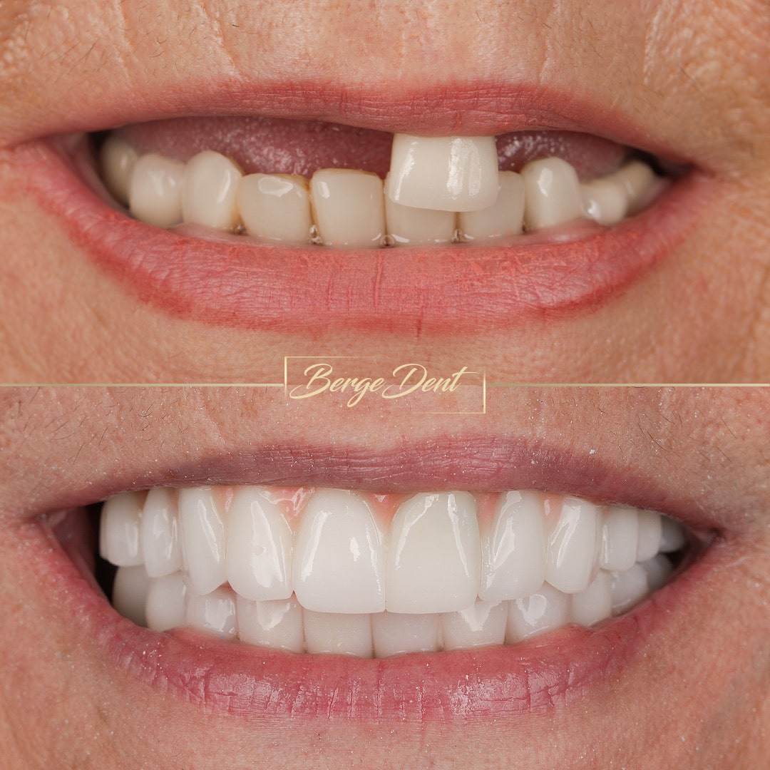 Dental Treatments in Turkey