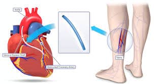 valve replacement surgery