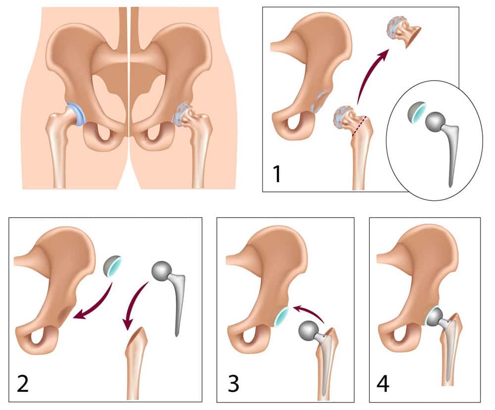 Hip Replacement Surgery in Turkey