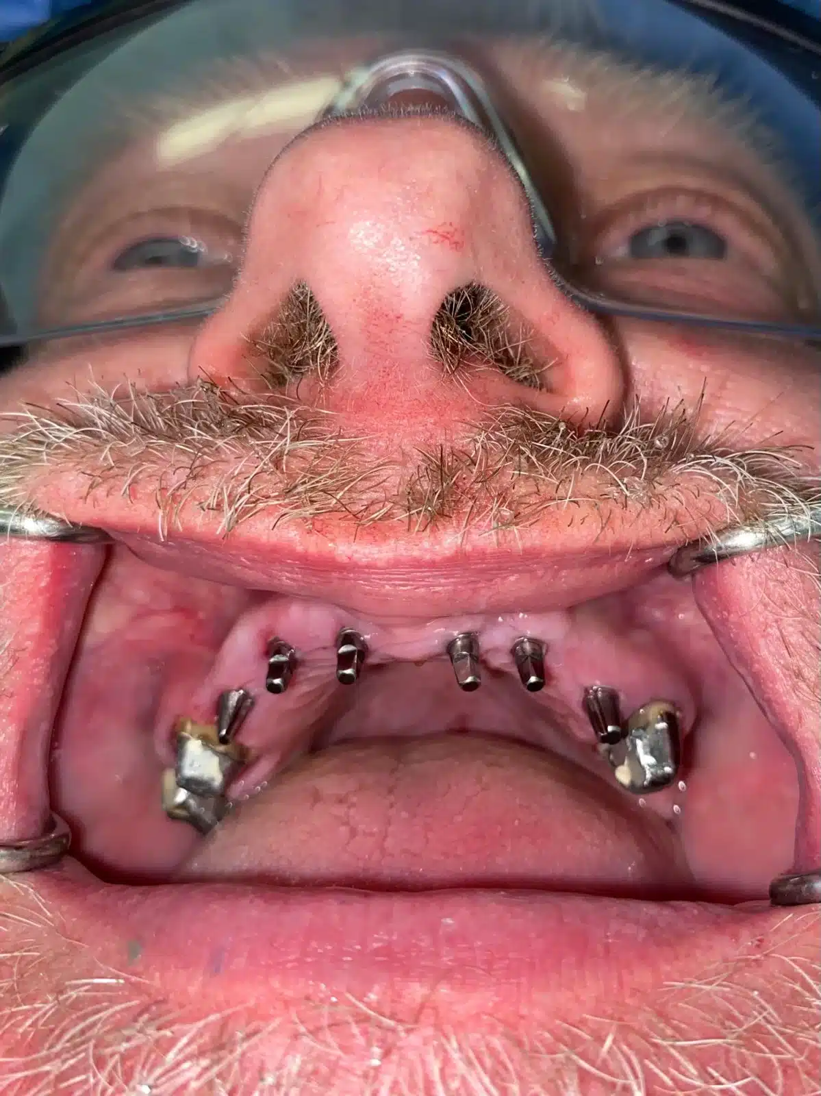 Full Mouth Restoration With Corticobasal Implants