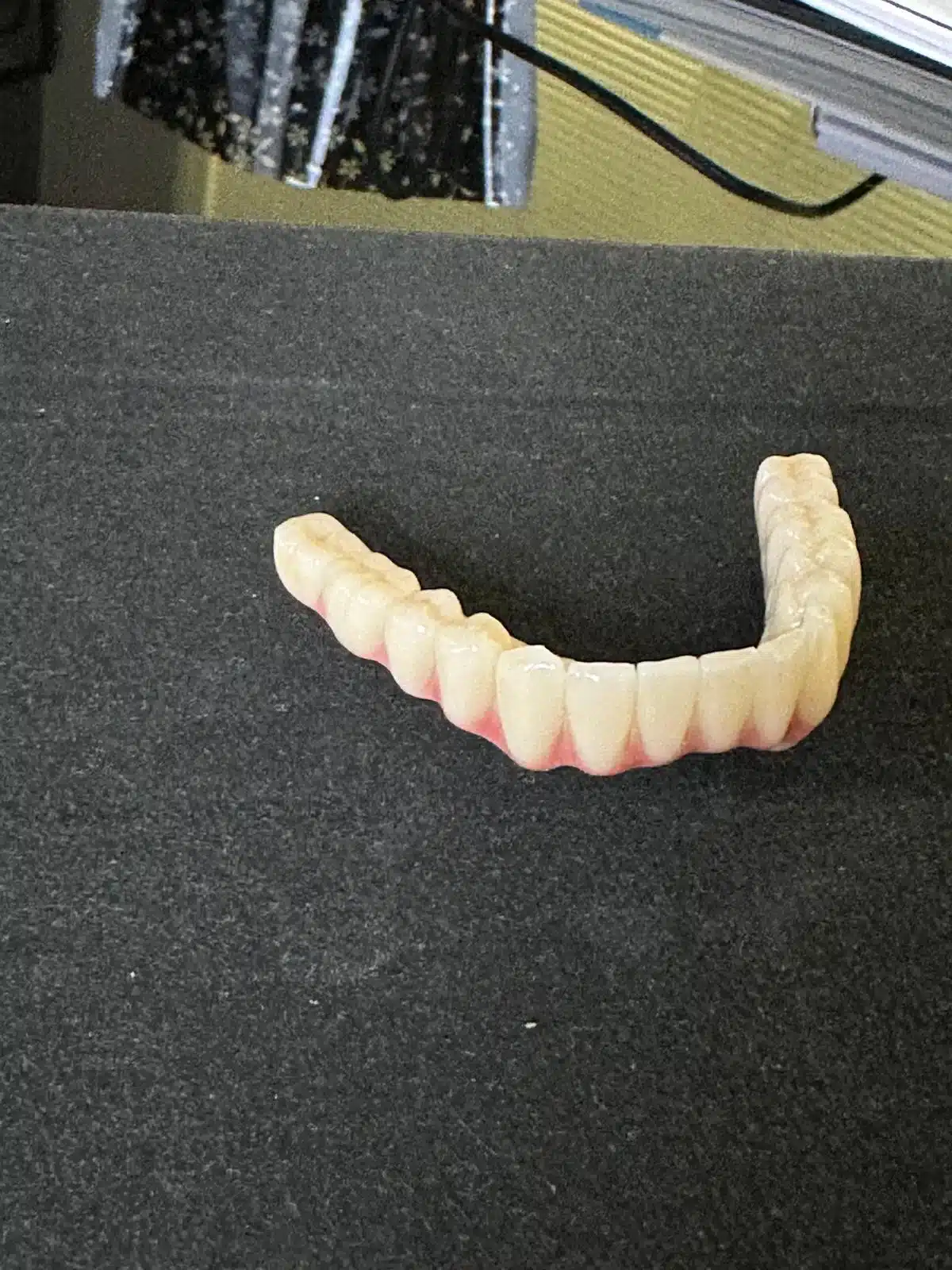 Full Mouth Restoration With Corticobasal Implants