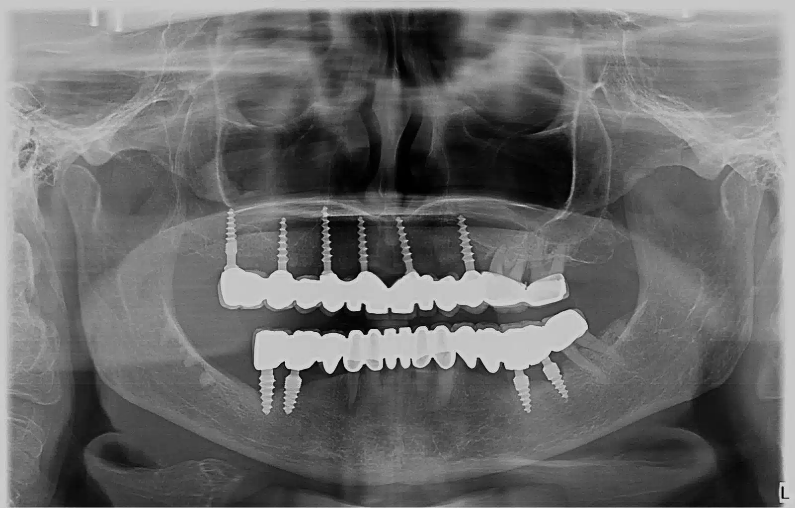 Full Mouth Restoration With Corticobasal Implants