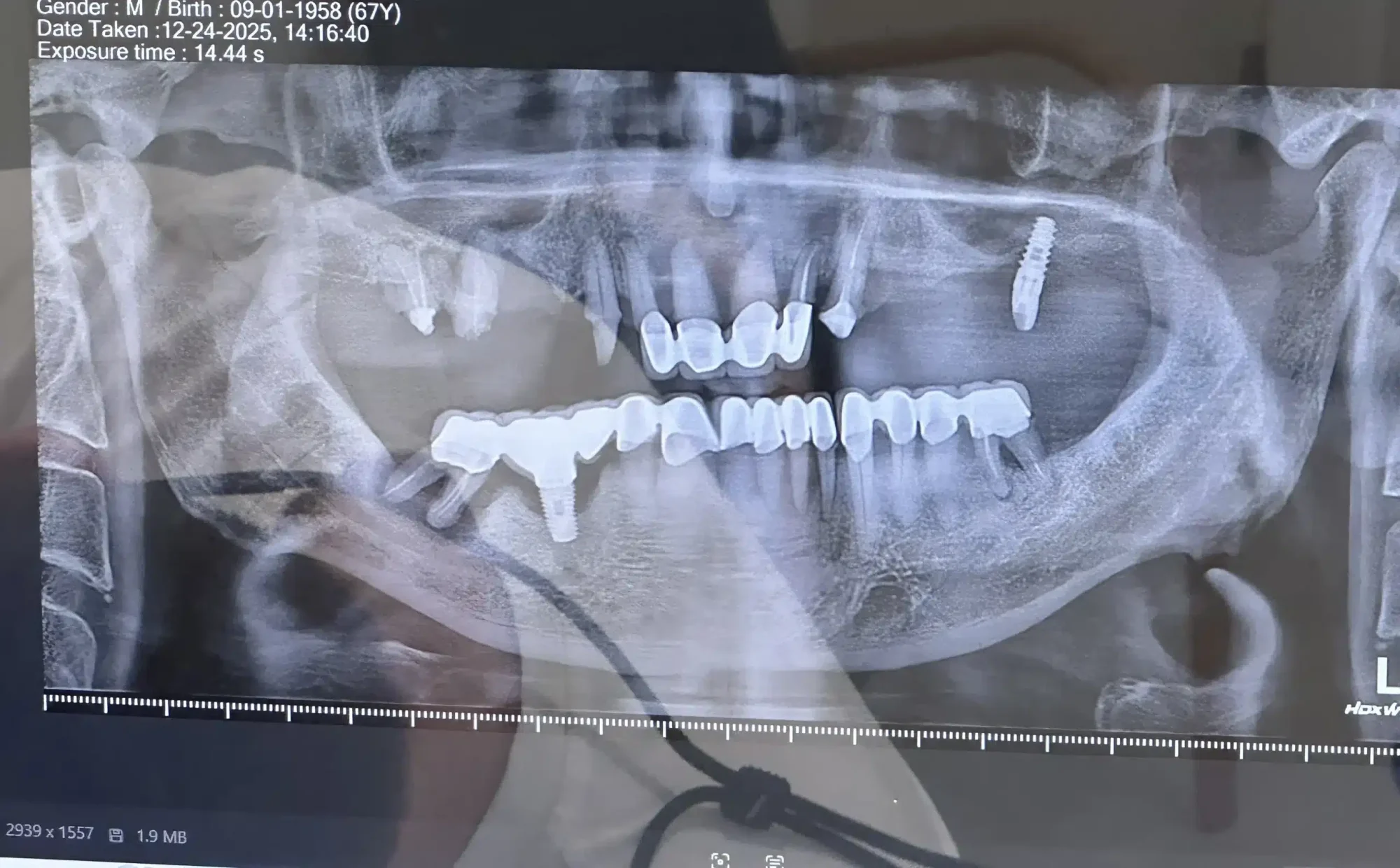 dr mehmet salih yıldırım corticobasal implants