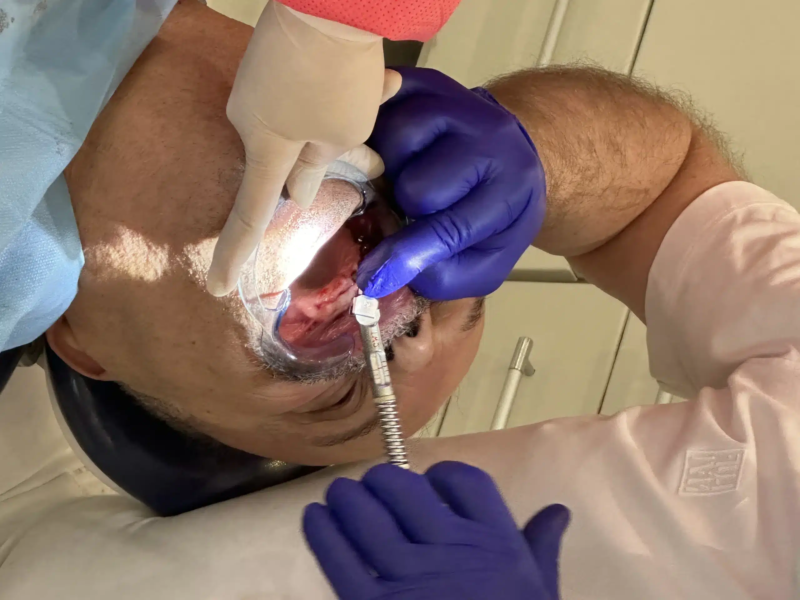 dr mehmet salih yıldırım corticobasal implants