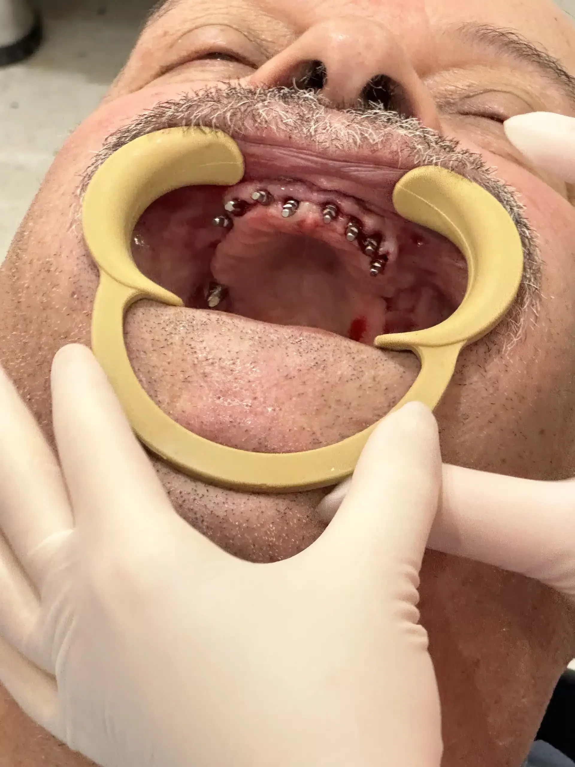dr mehmet salih yıldırım corticobasal implants