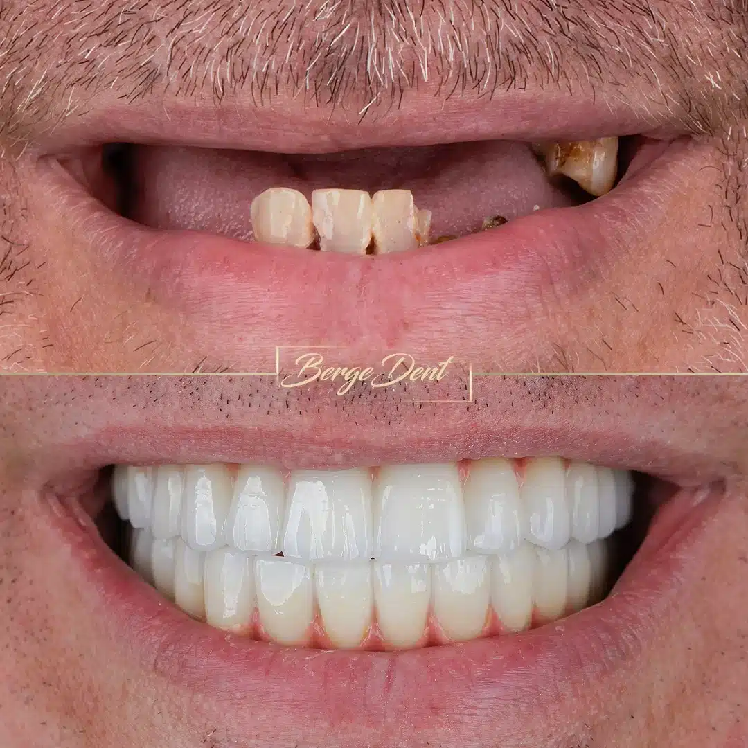 full mouth implants in turkey