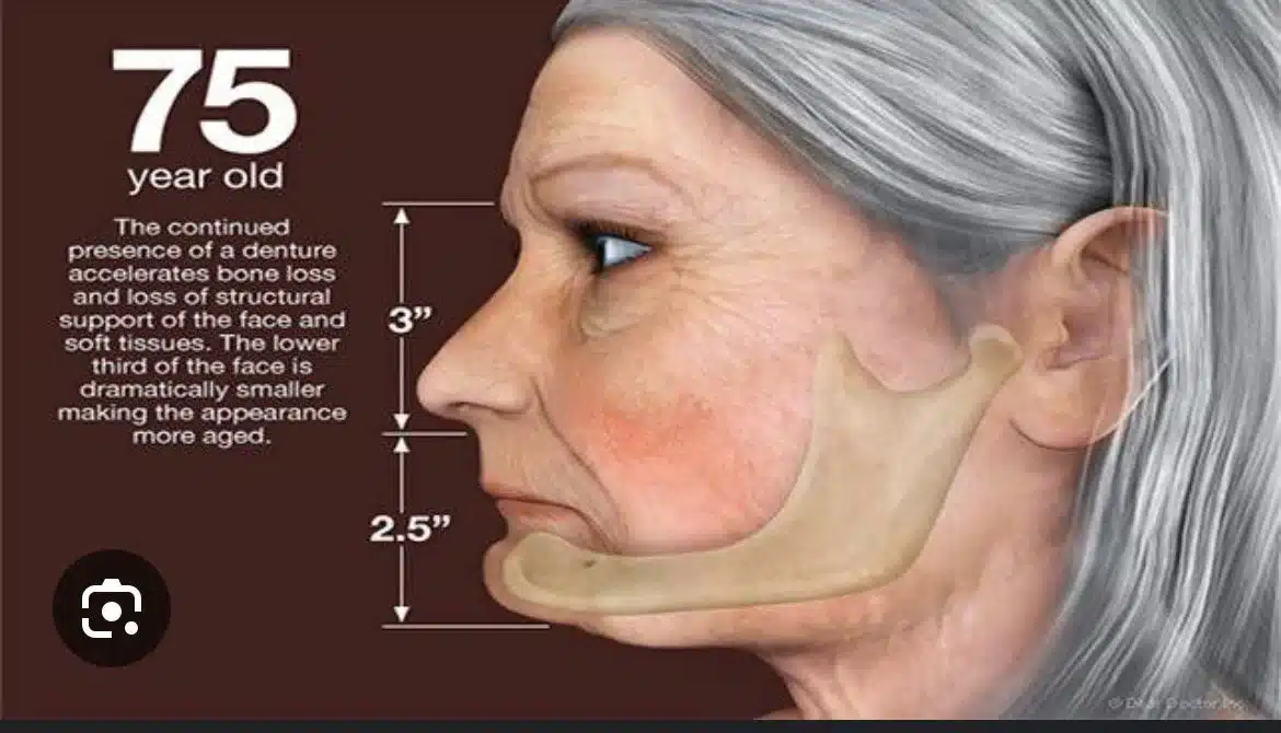 full mouth implants in turkey