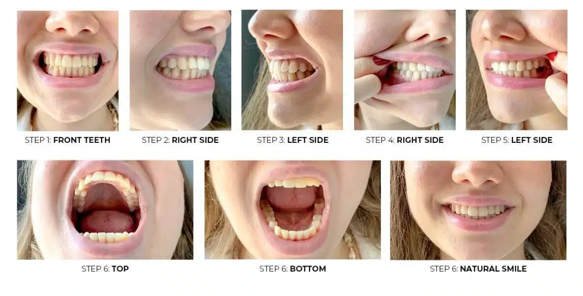 full mouth implants in turkey