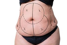 liposuction in turkey
