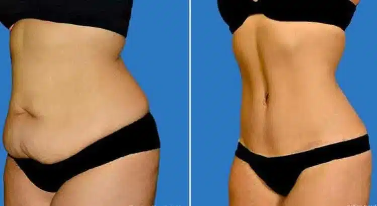 Lower body lift in Turkey