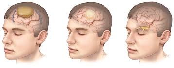 Neurology and Neurosurgery in Turkey