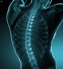 Spinal Fusion Surgery