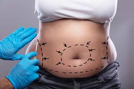 bariatric surgery turkey