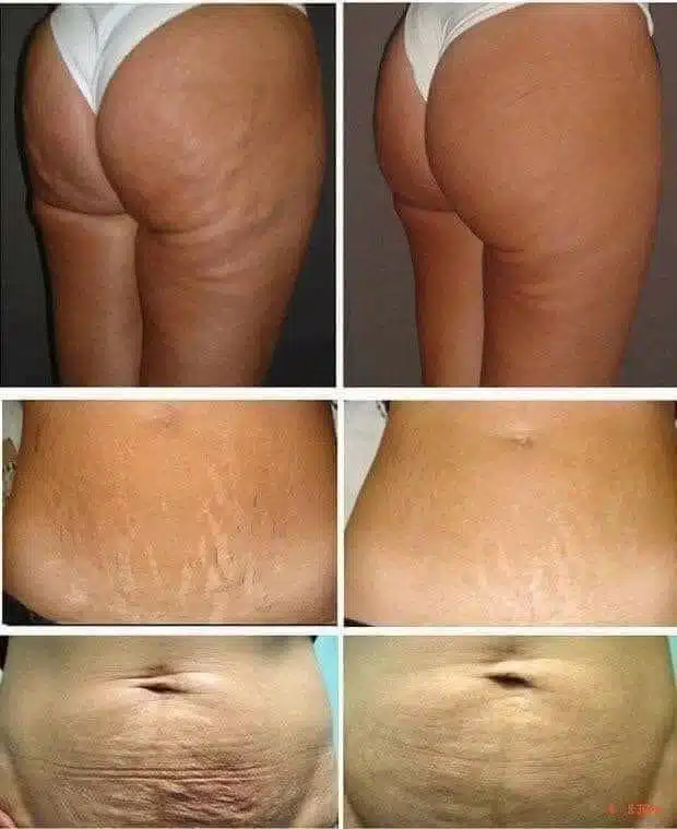 Brazilian Butt Lift 4 Lipo 360 contouring diagram