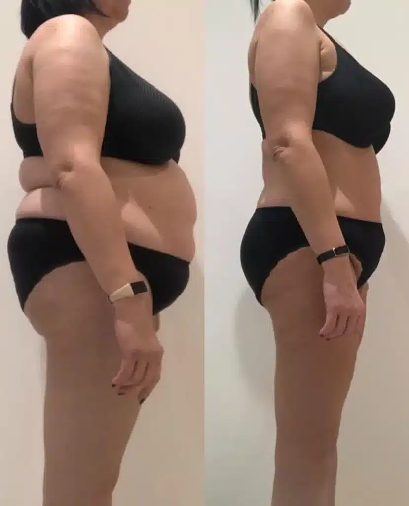 Body Lift 6 Fleur-de-lis abdominoplasty incision pattern visual